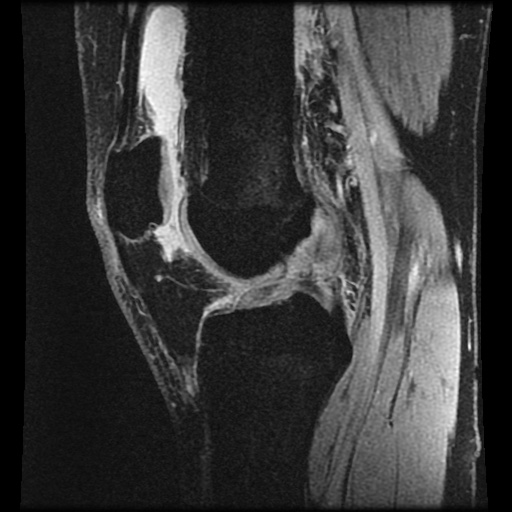 File:Anterior cruciate ligament tear (Radiopaedia 61500-69462 F 46).jpg