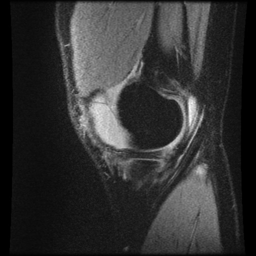 Anterior cruciate ligament tear (Radiopaedia 61500-69462 F 6).jpg