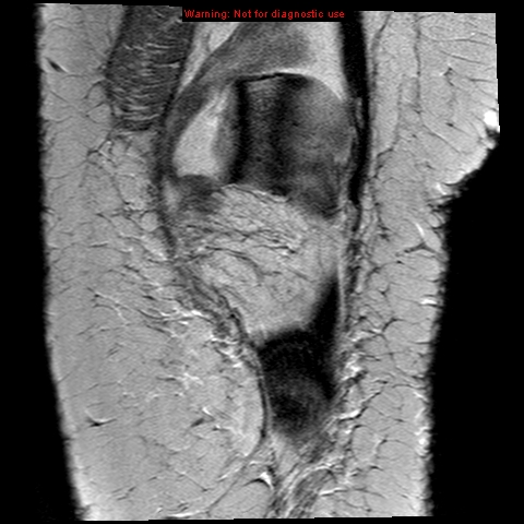 File:Anterior cruciate ligament tear - complete (Radiopaedia 12175-12514 C 1).jpg