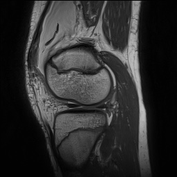 File:Anterior cruciate ligament tear - pediatric (Radiopaedia 62152-70260 Sagittal PD 128).jpg
