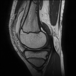 File:Anterior cruciate ligament tear - pediatric (Radiopaedia 62152-70260 Sagittal PD 59).jpg