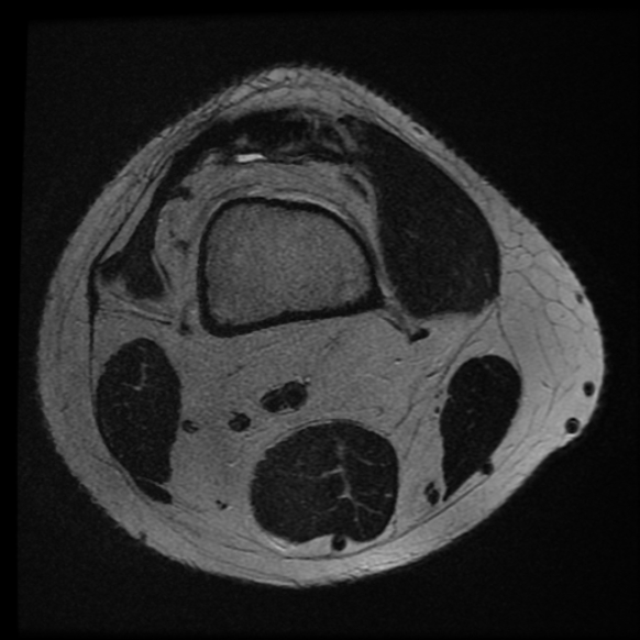 File:Anterior cruciate ligament tear with posteromedial corner injury, bucket-handle meniscal tear and chondral delamination (Radiopaedia 75501-86744 Axial T2 26).jpg