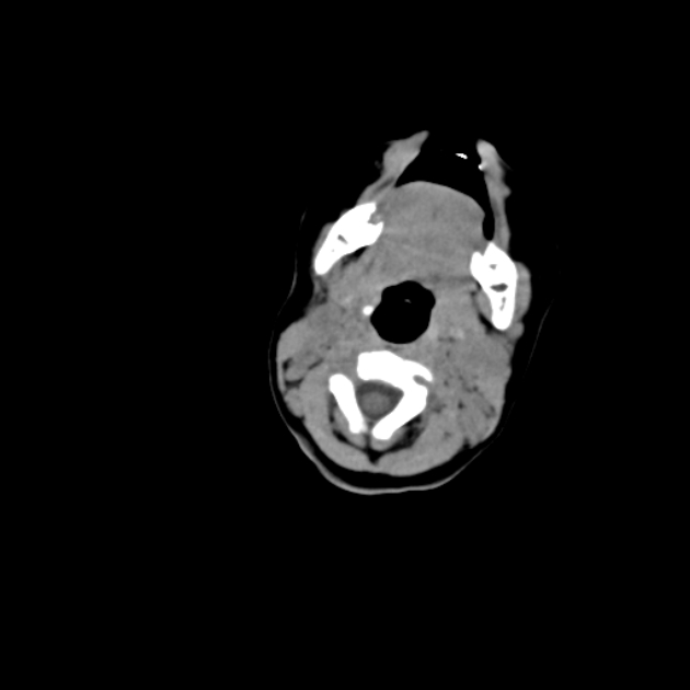 Anterior fontanelle inclusion cyst (Radiopaedia 62003-70087 Axial non-contrast 7).jpg