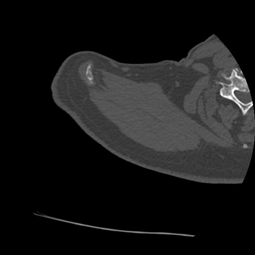 Anterior glenohumeral dislocation with Hill-Sachs lesion (Radiopaedia 62877-71249 Axial bone window 6).jpg