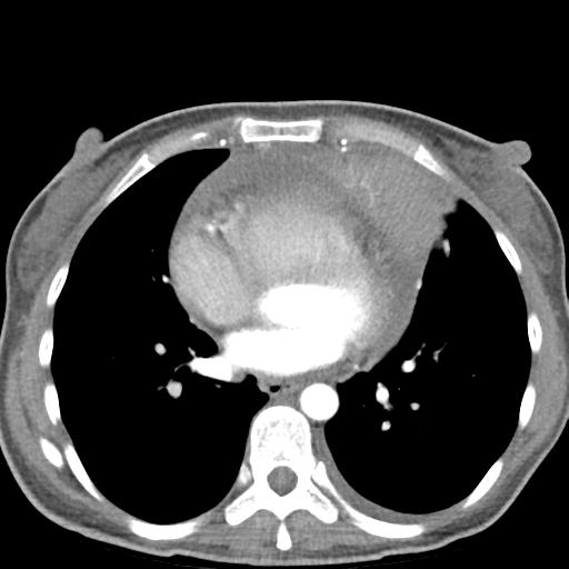 Anterior mediastinal lymphoma (Radiopaedia 29556-30061 C 34).jpg
