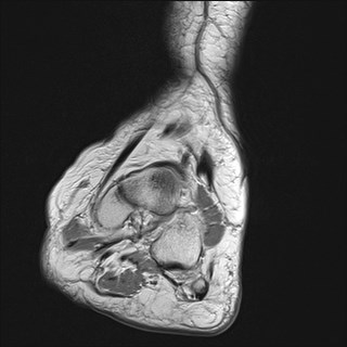 File:Anterior talofibular ligament injury - rupture with soft-tissue impingement (Radiopaedia 38765-40928 Coronal PD 26).jpg