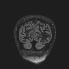 Anterior temporal encephalocele (Radiopaedia 82624-96808 Coronal FLAIR 47).jpg