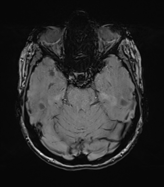 File:Anterior temporal lobe perivascular space (Radiopaedia 40946-43650 Axial SWI 29).png
