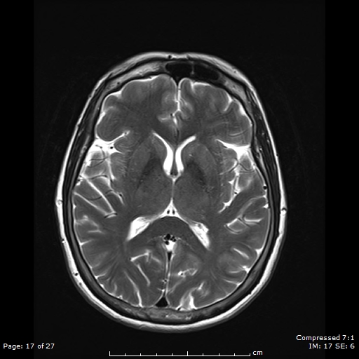 File:Anterior temporal lobe perivascular space (Radiopaedia 88283-104914 Axial T2 17).jpg