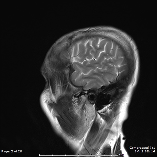File:Anterior temporal lobe perivascular space (Radiopaedia 88283-104914 Sagittal T2 2).jpg