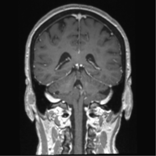 Anterior temporal pole cysts (Radiopaedia 46629-51102 Coronal T1 C+ 63).png