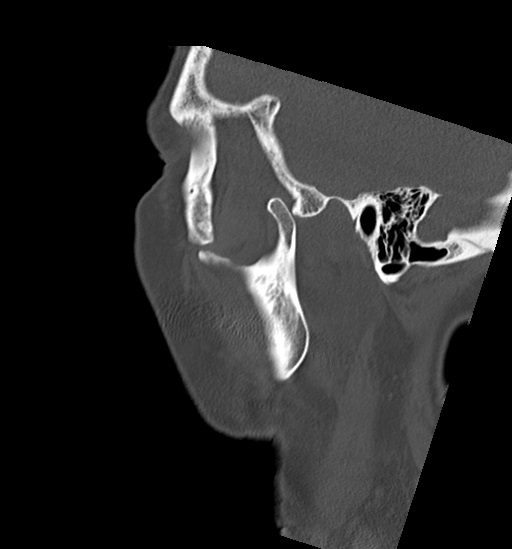 Anterior temporomandibular joint dislocation (Radiopaedia 59430-66784 B 8).jpg