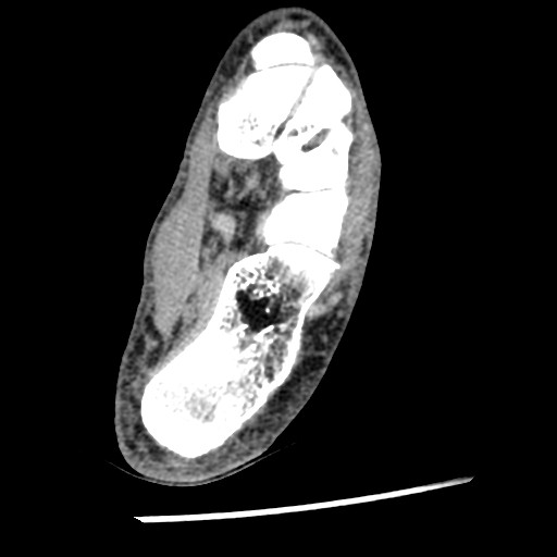 Anterior tibial artery false aneurysm (Radiopaedia 88984-105809 A 192).jpg
