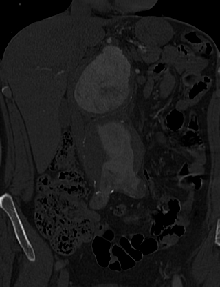 Anterior vertebral scalloping (abdominal aortic aneurysm) (Radiopaedia 66744-76067 Coronal bone window 8).jpg