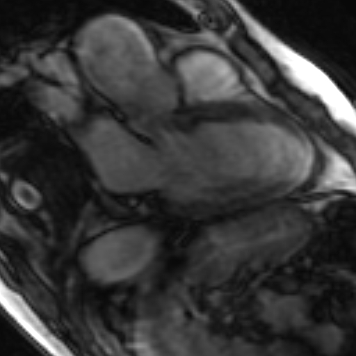 File:Anteroseptal hypokinesia after myocardial infarction (Radiopaedia 15978-15633 3 chamber view SSFE 22).jpg