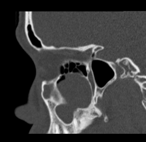 File:Antrochoanal polyp (Radiopaedia 33984-35202 Sagittal bone window 27).jpg