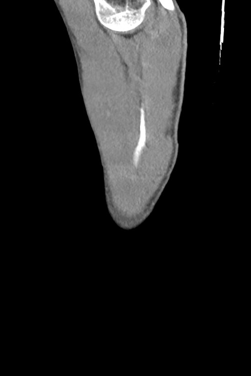 Aortic coarctation with aneurysm (Radiopaedia 74818-85828 B 3).jpg