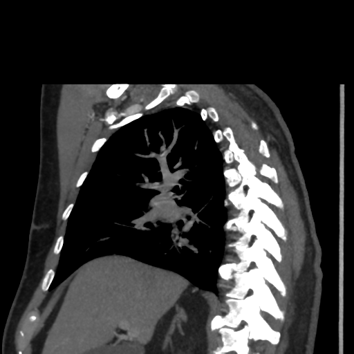 File:Aortic dissection- Stanford A (Radiopaedia 37759-39664 D 3).png