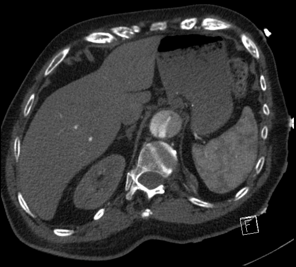 Aortic dissection (CTPA) (Radiopaedia 75506-86750 A 86).jpg