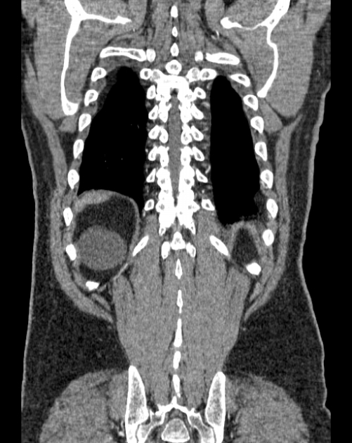 Aortic dissection (Radiopaedia 44411-48061 A 62).jpg