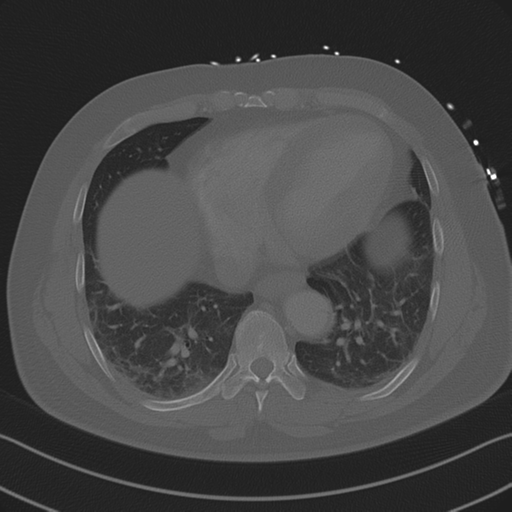 Aortic dissection (Radiopaedia 50763-56234 Axial bone window 74).png