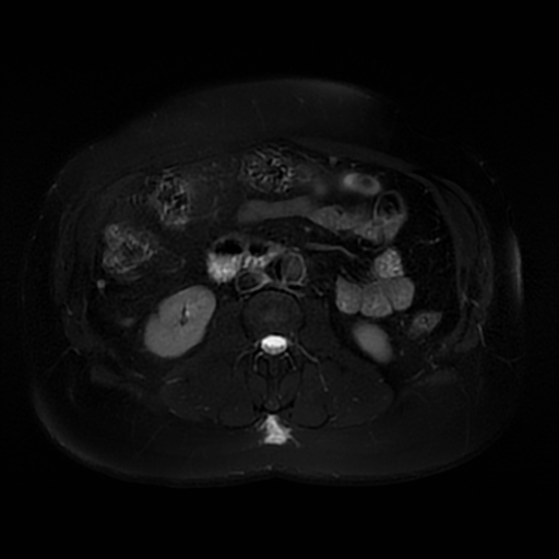File:Aortic dissection (Radiopaedia 57969-64956 Axial T2 fat sat 37).jpg