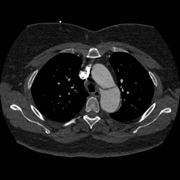 Aortic dissection (Radiopaedia 57969-64959 A 102).jpg