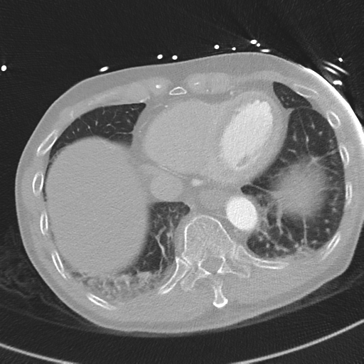 Aortic dissection - DeBakey type II (Radiopaedia 64302-73082 Axial lung window 50).png
