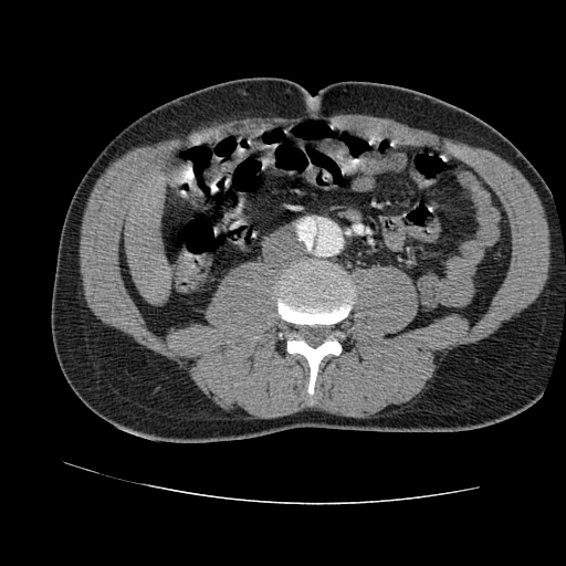 File:Aortic dissection - Stanford A -DeBakey I (Radiopaedia 28339-28587 B 151).jpg