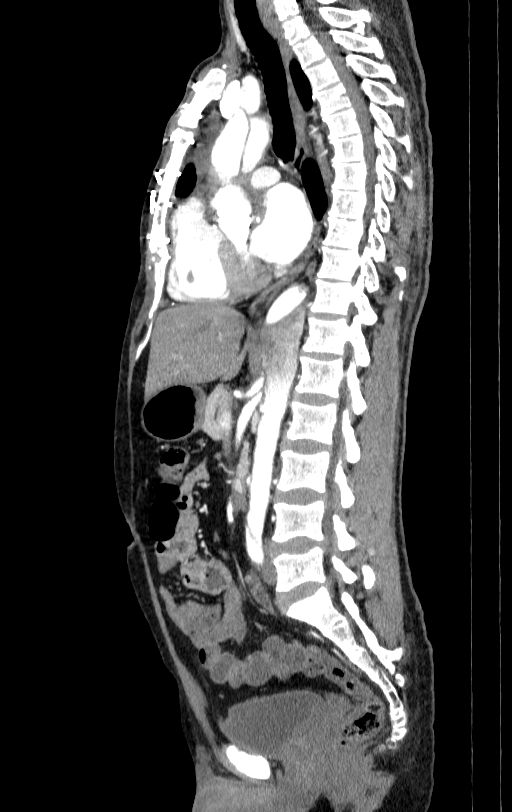 Aortic dissection - Stanford type A (Radiopaedia 83418-98500 B 36).jpg