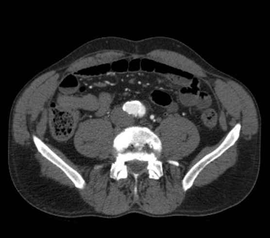 Aortic dissection - Stanford type B (Radiopaedia 73648-84437 A 196).jpg