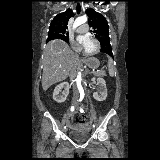 File:Aortic dissection - Stanford type B (Radiopaedia 88281-104910 B 33).jpg