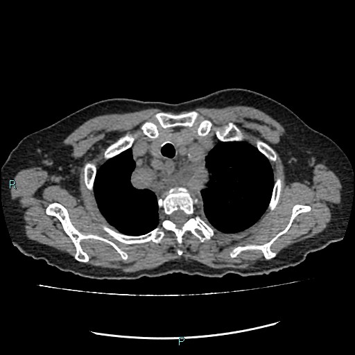 File:Aortic dissection extended to lusory artery (Radiopaedia 43686-47136 Axial non-contrast 5).jpg