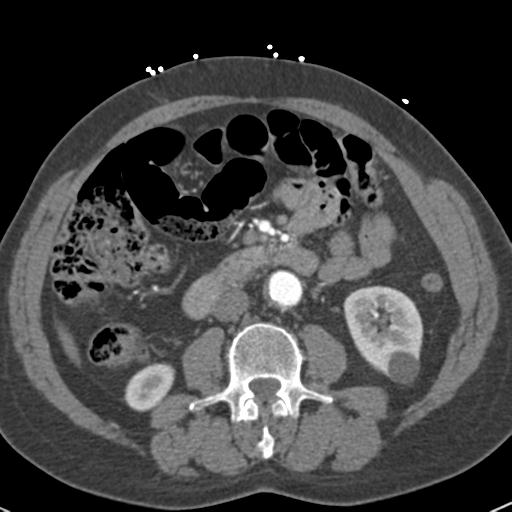 Aortic intramural hematoma (Radiopaedia 31139-31838 B 107).jpg