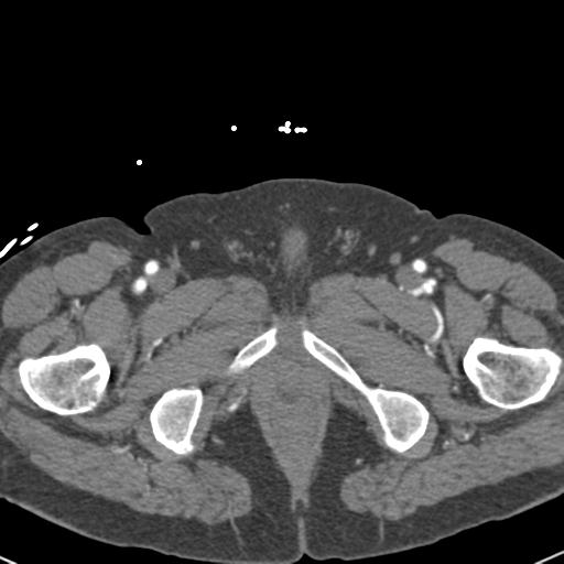 File:Aortic intramural hematoma (Radiopaedia 31139-31838 B 177).jpg