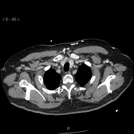 File:Aortic intramural hematoma (Radiopaedia 48463-53380 C 22).jpg