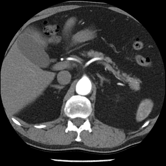Aortic intramural hematoma (type B) (Radiopaedia 79323-92387 B 59).jpg