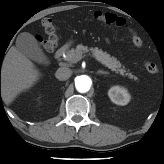 File:Aortic intramural hematoma (type B) (Radiopaedia 79323-92387 B 62).jpg