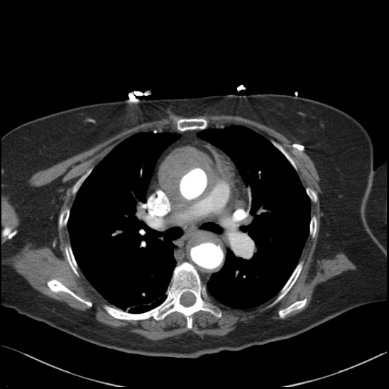Aortic intramural hematoma with dissection and intramural blood pool (Radiopaedia 77373-89491 B 53).jpg
