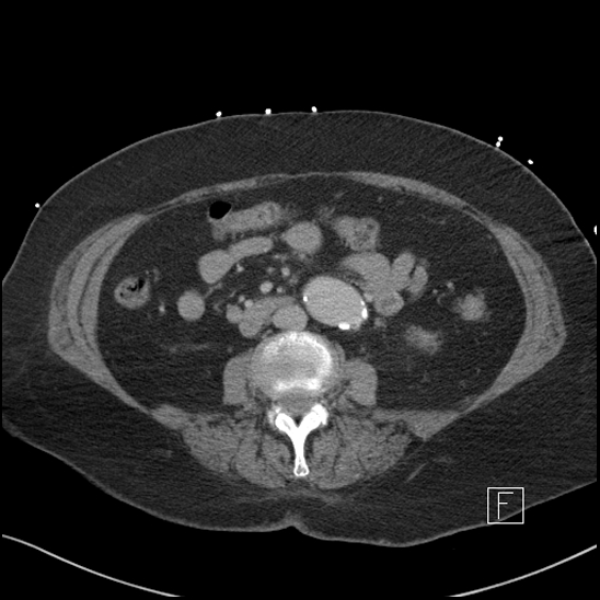 Aortic intramural hematoma with dissection and intramural blood pool (Radiopaedia 77373-89491 E 42).jpg