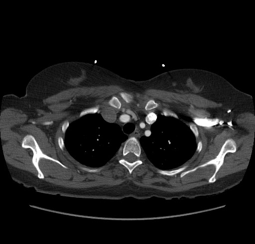 Aortic nipple (Radiopaedia 63008-71449 B 15).jpg