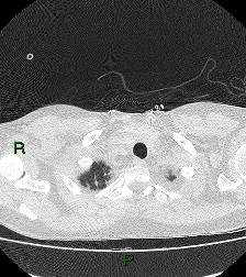 File:Aortic valve endocarditis (Radiopaedia 87209-103485 Axial lung window 14).jpg