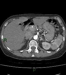 Aortic valve endocarditis (Radiopaedia 87209-103485 C 99).jpg