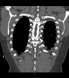 Aortic valve endocarditis (Radiopaedia 87209-103485 D 12).jpg
