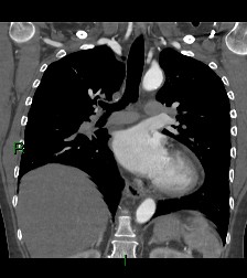File:Aortic valve endocarditis (Radiopaedia 87209-103485 D 32).jpg