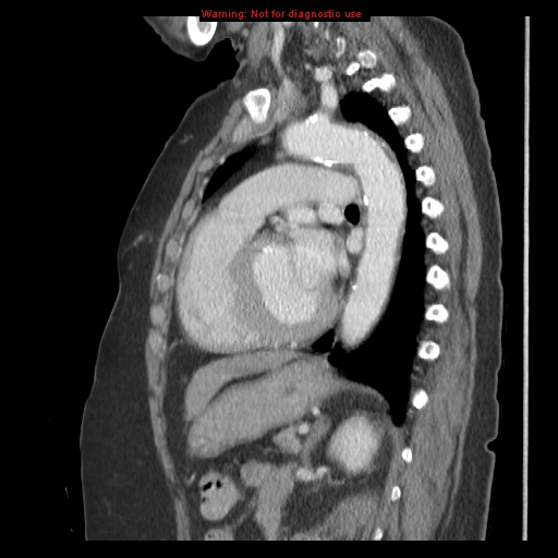 File:Aortic valve stenosis (Radiopaedia 14480-14423 B 9).jpg