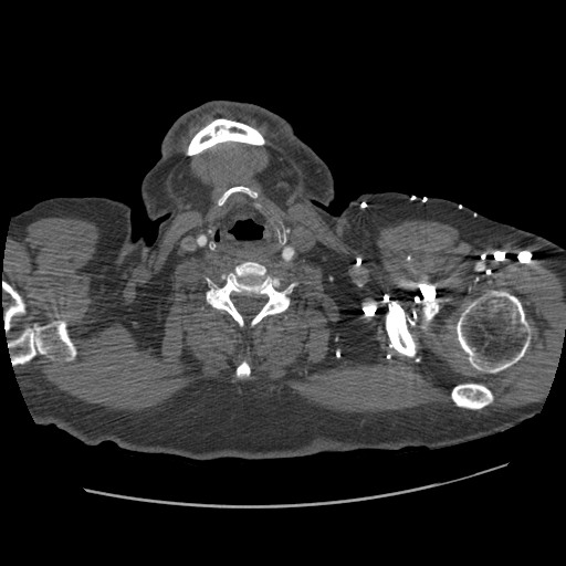 File:Aorto-coronary bypass graft aneurysms (Radiopaedia 40562-43157 A 4).png