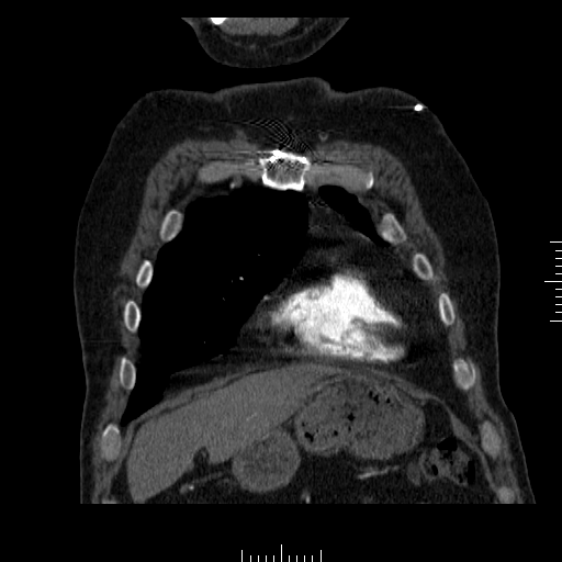 File:Aorto-coronary bypass graft aneurysms (Radiopaedia 40562-43157 B 7).png