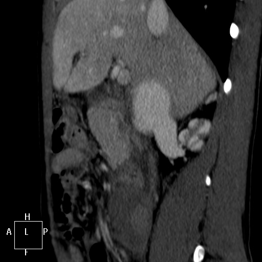 Aorto-left renal vein fistula (Radiopaedia 45534-49628 C 12).jpg