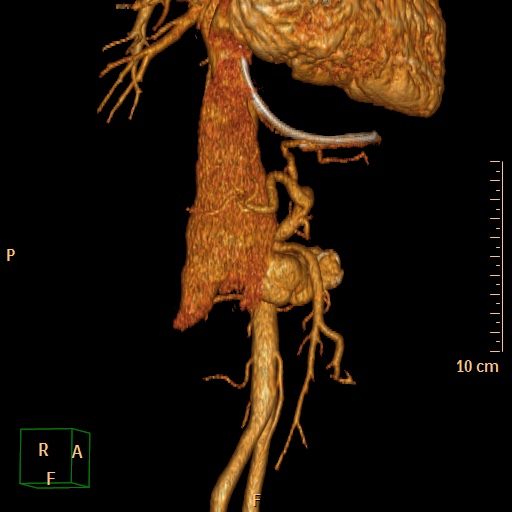 File:Aorto-left renal vein fistula (Radiopaedia 45534-49628 D 13).jpg